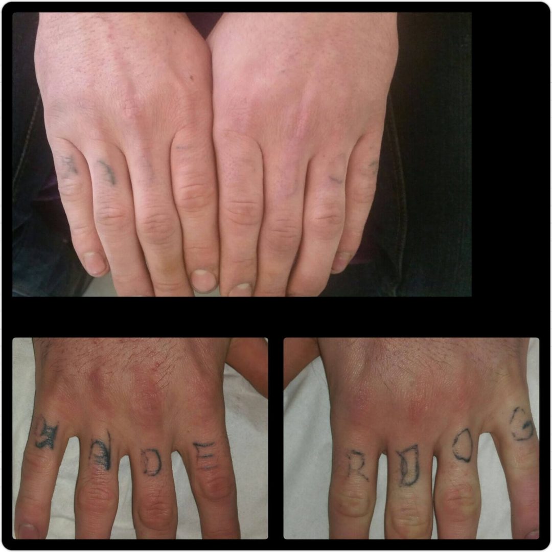 laser tattoo removal cheltenham forever clinic cheltenham laser tattoo removal cheltenham forever clinic cheltenham