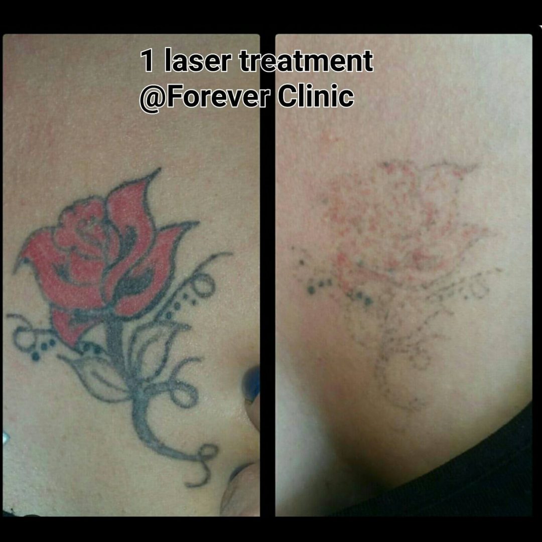 Laser Tattoo Removal Cheltenham - Forever Clinic - Cheltenham
