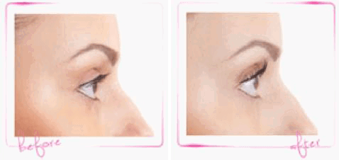 LVL Eyelash Lift Cheltenham - Forever Clinic - Cheltenham