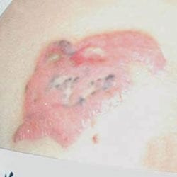 non laser tattoo removal cheltenham forever clinic cheltenham non laser tattoo removal cheltenham forever clinic cheltenham