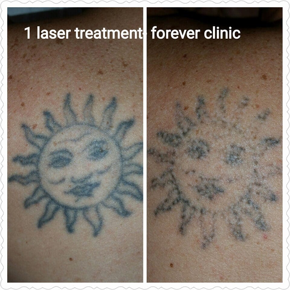 treatments gallery cheltenham forever clinic cheltenham treatments gallery cheltenham forever clinic cheltenham