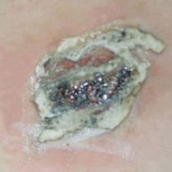 non laser tattoo removal cheltenham forever clinic cheltenham non laser tattoo removal cheltenham forever clinic cheltenham