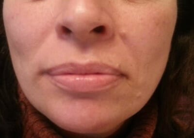 dermal fillers forever clinic cheltenham natural lift dermal fillers forever clinic cheltenham natural lift