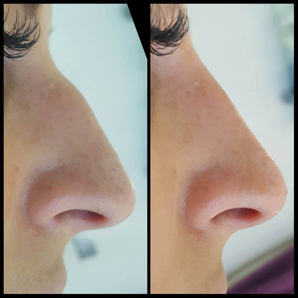 Non-Surgical Rhinoplasty