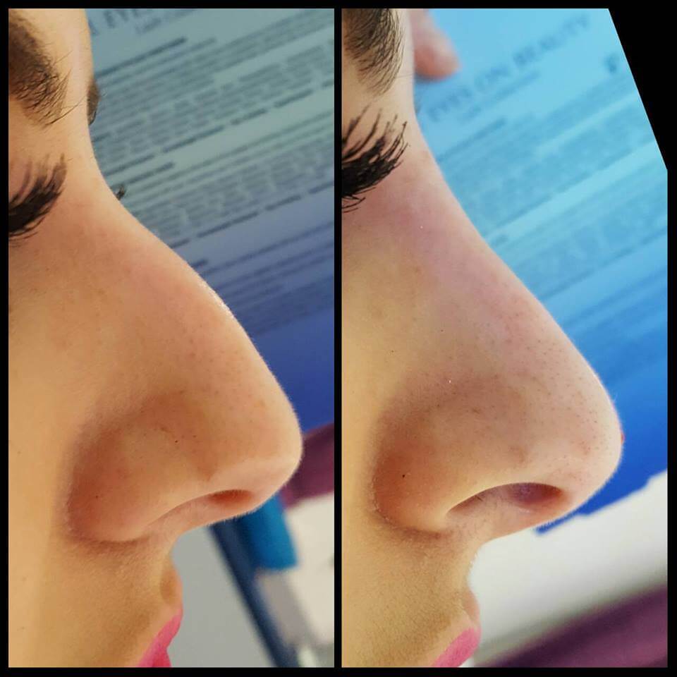 Non-Surgical Rhinoplasty