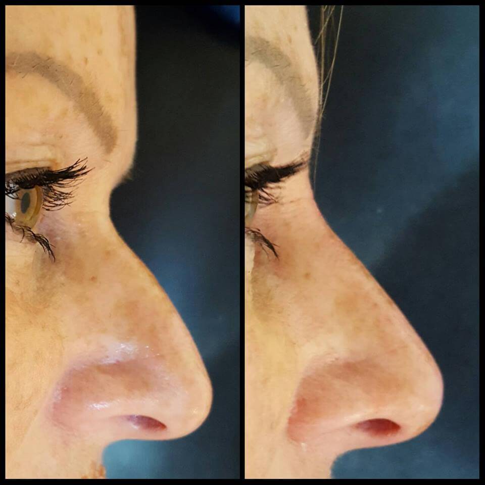 Non-Surgical Rhinoplasty