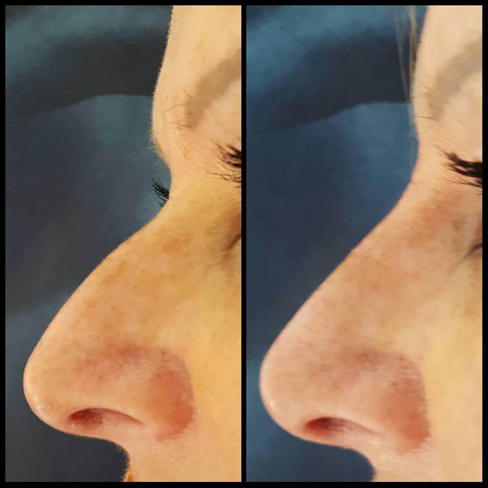 Non-Surgical Rhinoplasty