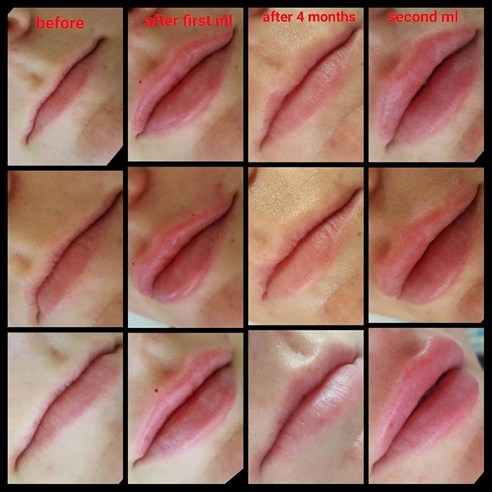 Lip Filler Forever Clinic Cheltenham