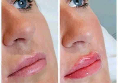 lip fillers