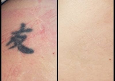 Laser tattoo Removal