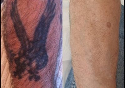 Laser tattoo Removal