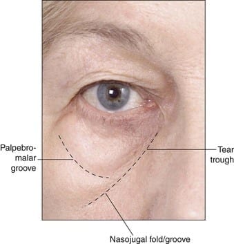 Tear Trough and Nasojugal Fold Augmentation | Reducing of ...