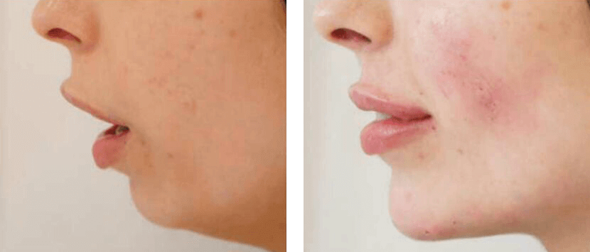 Chin Augmentation and Jaw Definition