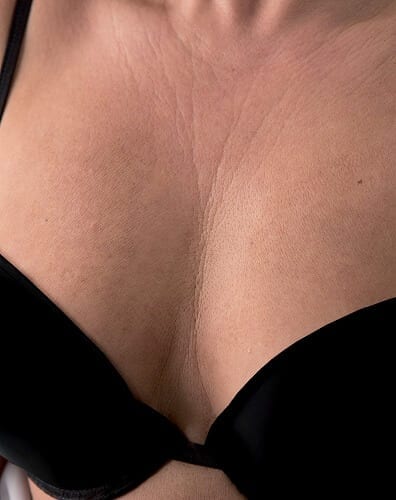 Skin Rejuvenating Injections Skin Rejuvenating Injections - Mesotherapy before