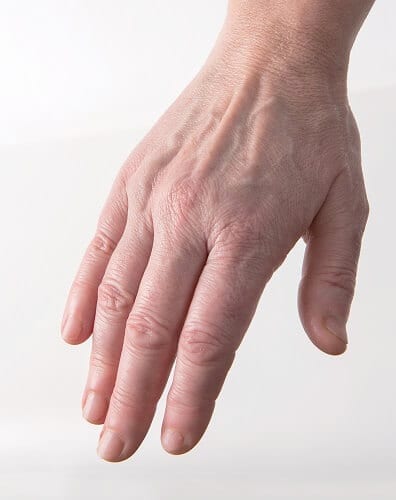 Skin Rejuvenating Injections Skin Rejuvenating Injections - Mesotherapy before