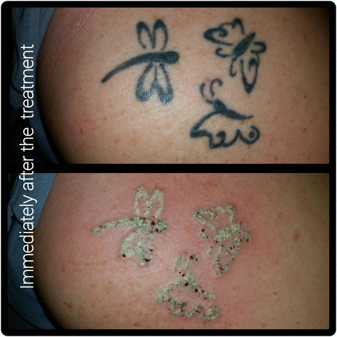 Laser Tattoo Removal Timeline / Does Laser Tattoo Removal Hurt? | WIFH / Many patients describe it as like having a heavy rubber band snapped against the skin repeatedly.