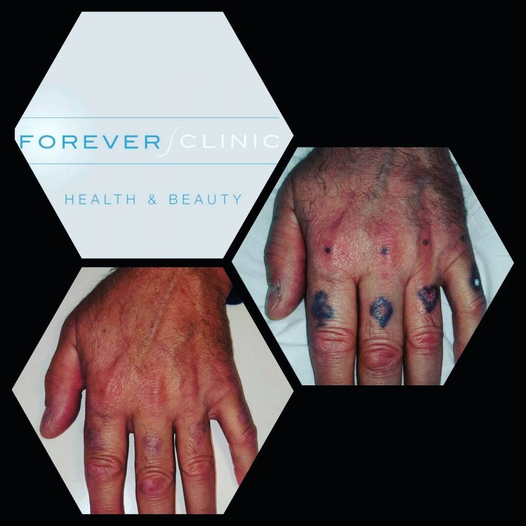 Laser Tattoo Removal Cheltenham - Forever Clinic | Cheltenham