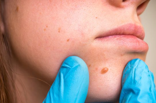 Moles