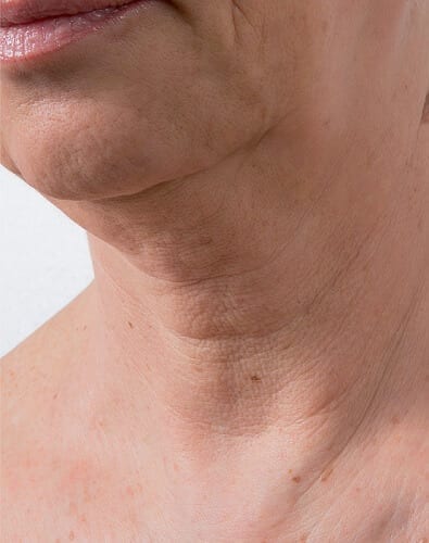 Mesotherapy before Skin Rejuvenating Injections Skin Rejuvenating Injections