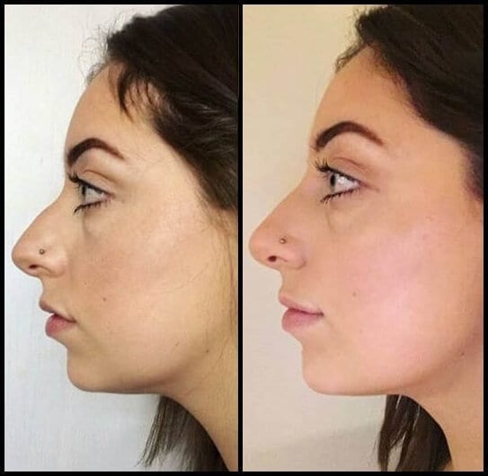 Non-Surgical Rhinoplasty