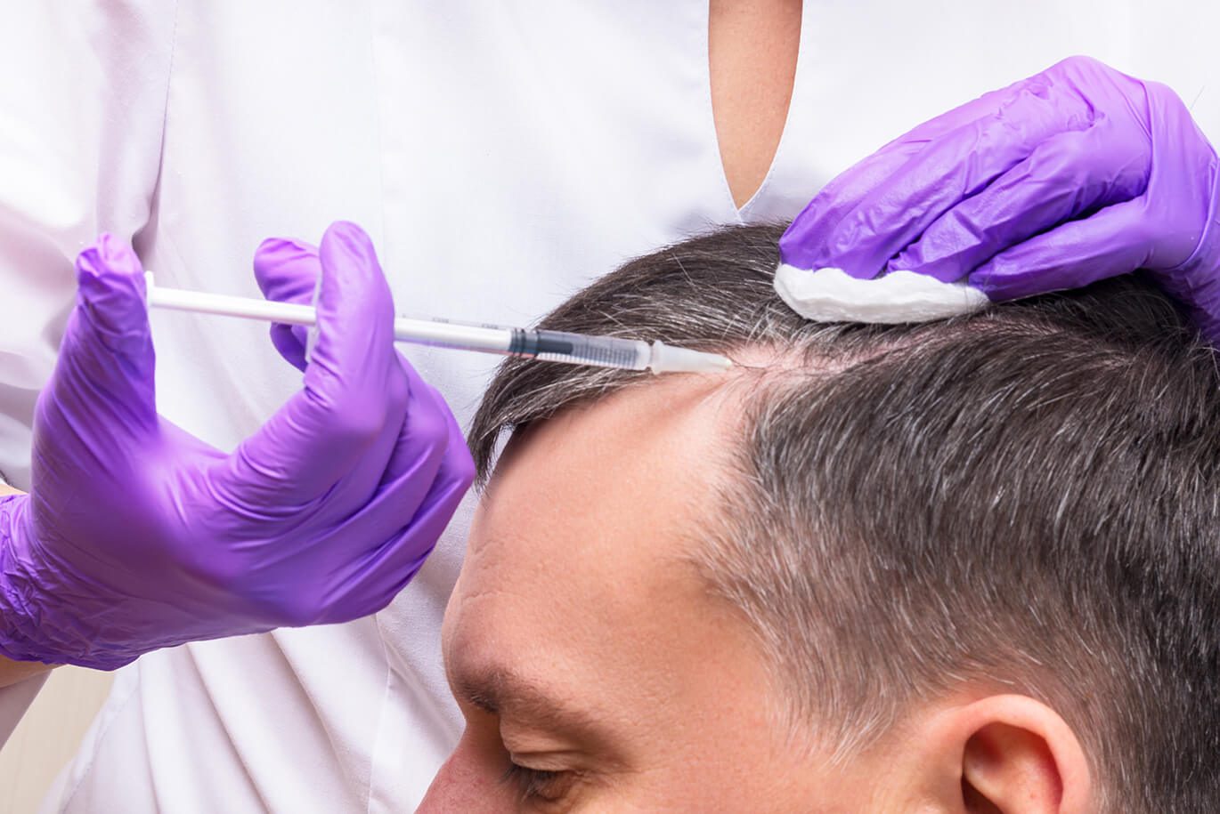 PRP-for-Hair-Loss