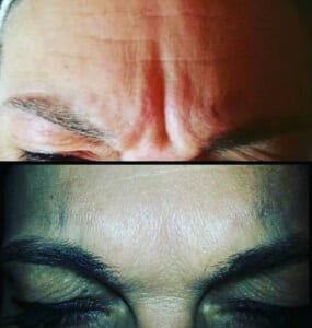 Injections like botox in Cheltenham