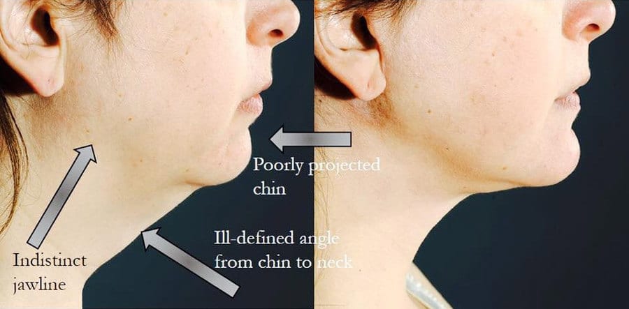 Chin Augmentation and Jaw Definition